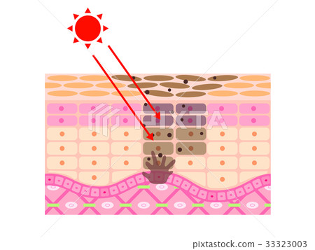 Skin sectional view sunburn stain 33323003