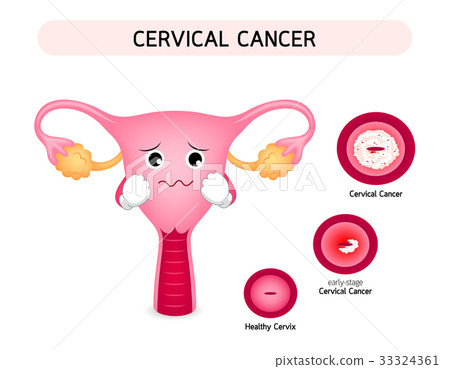 Cervical cancer diagram with sadness uterus. 33324361