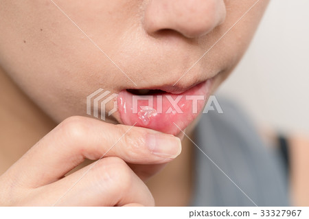 Close up of woman with aphtha Close up of woman with aphtha 33327967