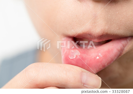 Woman suffer from mouth aphtha Woman suffer from mouth aphtha 33328087