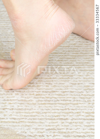 女腳後跟裂縫 33334567