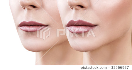 Lips of adult woman before and after augmentation 33366927