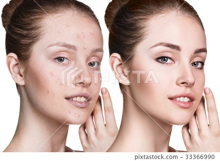 Young woman with acne before and after treatment 33366990