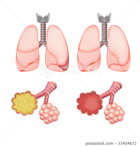 Alveoli In Lungs Set Alveoli In Lungs Set 33404672
