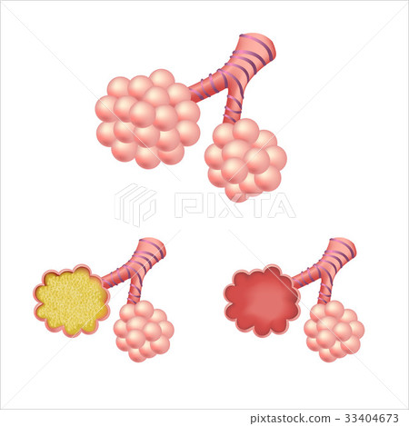 Alveoli In Set Alveoli In Set 33404673