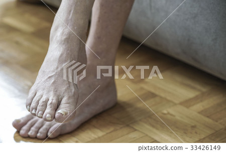 damaged nails because of fungus and athlete's foot 33426149