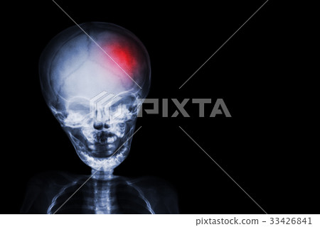 Stroke . Stroke . 33426841