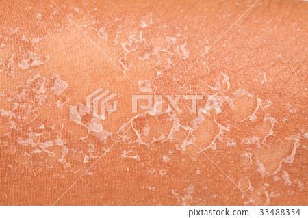 peeling of skin after burned by sunlight 33488354