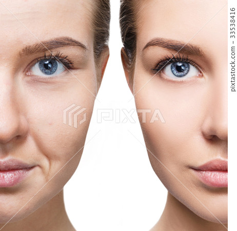 Woman's face before and after rejuvenation. 33538416
