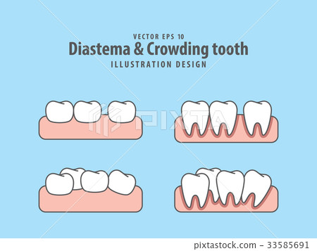 Diastema & Crowding tooth illustration vector Diastema & Crowding tooth illustration vector 33585691
