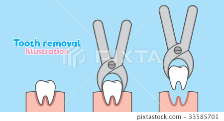Step of Tooth removal illustration vector on blue Step of Tooth removal illustration vector on blue 33585701