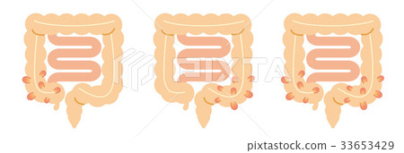 結腸直腸憩室炎的插圖 插圖素材 圖庫