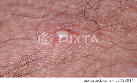 ingrown hair closeup 33726014