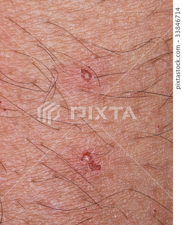 closeup of spot with scab over caucasian skin closeup of spot with scab over caucasian skin 33846714