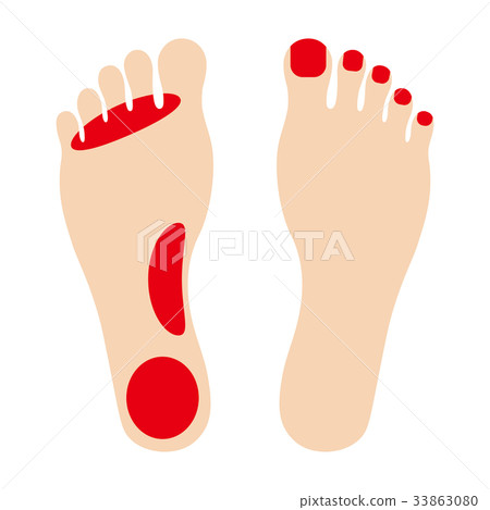 Asthma Asthma 33863080