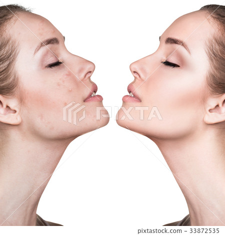 Woman with acne before and after treatment. 33872535