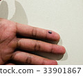 bruise in finger 33901867
