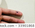 bruise in finger 33901868