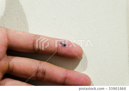 bruise in finger bruise in finger 33901868