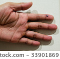 bruise in finger 33901869
