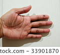bruise in finger 33901870