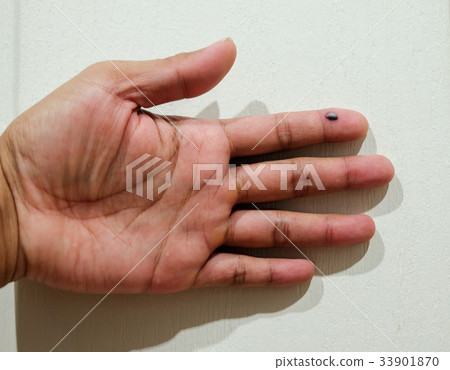 bruise in finger 33901870
