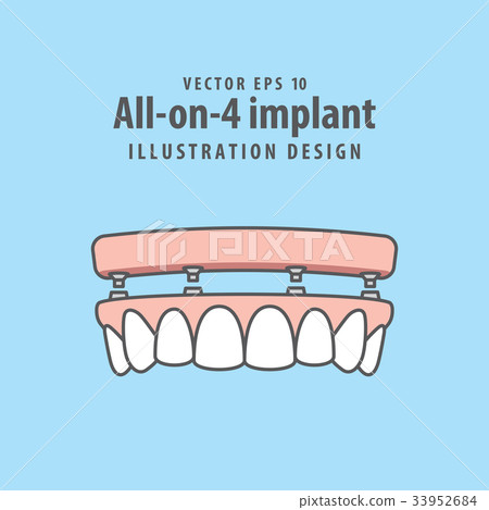 All-on-4 implant illustration vector. 33952684