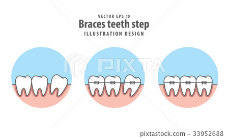 Braces teeth step in circle illustration vector Braces teeth step in circle illustration vector 33952688