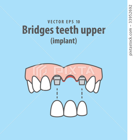 Bridges teeth upper (implant) illustration vector Bridges teeth upper (implant) illustration vector 33952692