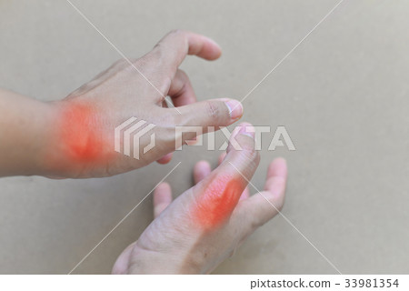 Painful and inflamed gout.. 33981354