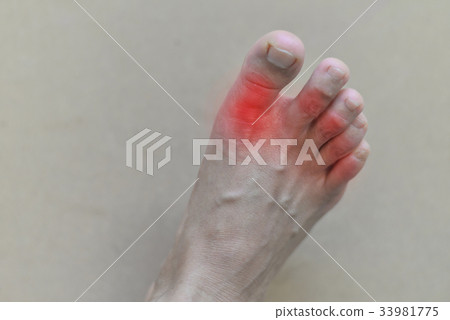 Painful and inflamed gout.. 33981775