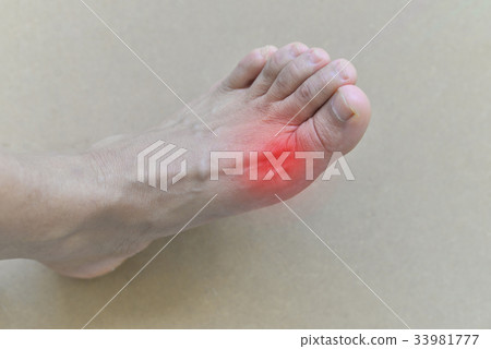 Painful and inflamed gout.. Painful and inflamed gout.. 33981777