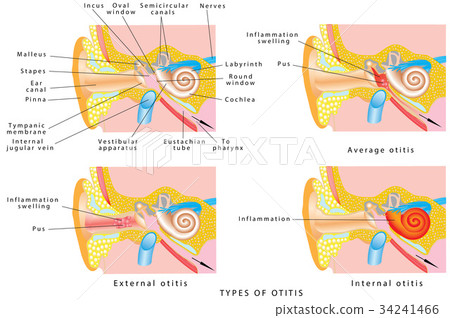 Ear otitis Ear otitis 34241466