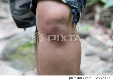 Wounds and blood on the knee Caused by running. 34273176