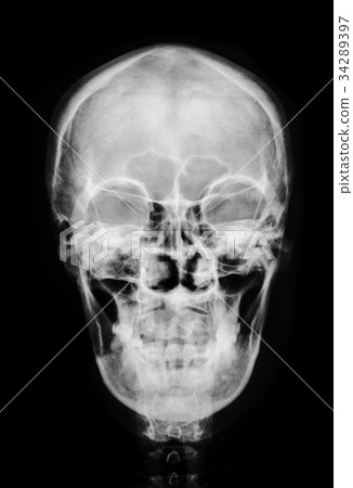 front face skull x-ray. 34289397