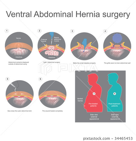 Ventral abdominal hernia surgery Ventral abdominal hernia surgery 34465453