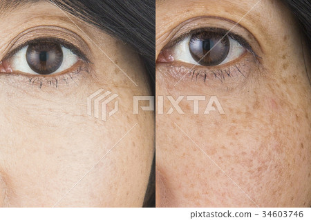 Before after image Before after image 34603746