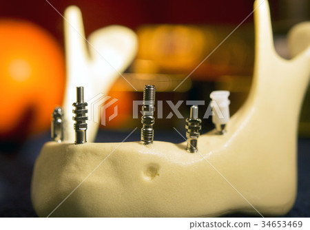 abutments in the artificial jawbone abutments in the artificial jawbone 34653469