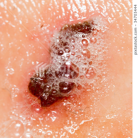Wound on human skin in hydrogen peroxide 34703444