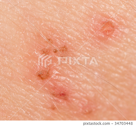 Wound on the skin of a person 34703448