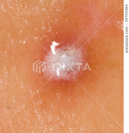 Wound on human skin in hydrogen peroxide 34703464