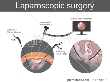 Laparoscopic surgery. Laparoscopic surgery. 34770995