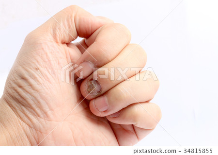 Fungus Infection on Nails Hand, Fungus Infection on Nails Hand, 34815855