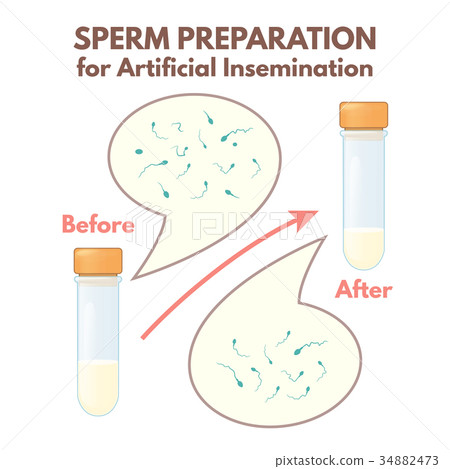 preparation of sperm preparation of sperm 34882473