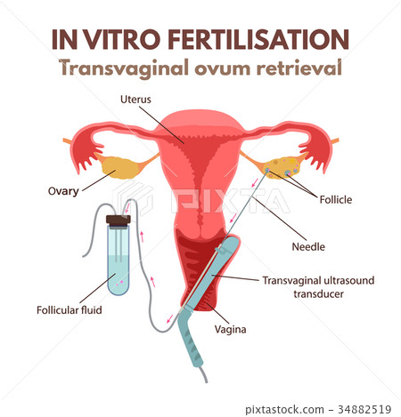 In vitro fertilisation 34882519