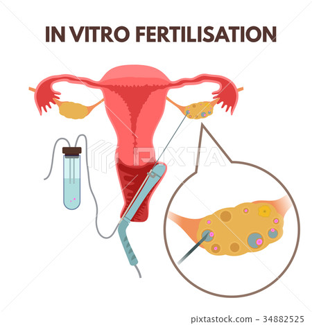 In vitro fertilisation In vitro fertilisation 34882525