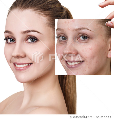 Woman shows photo with bad skin before treatment. Woman shows photo with bad skin before treatment. 34936633