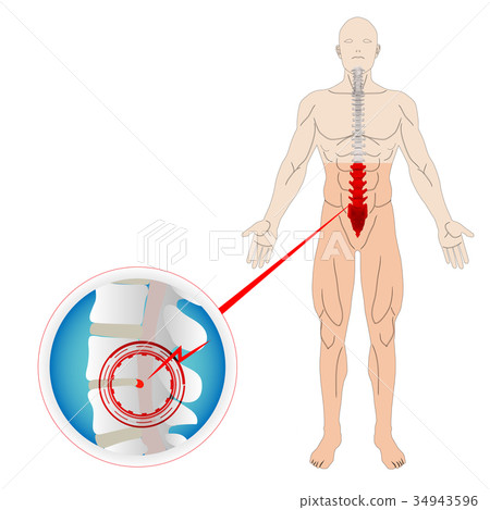 herniated disc herniated disc 34943596