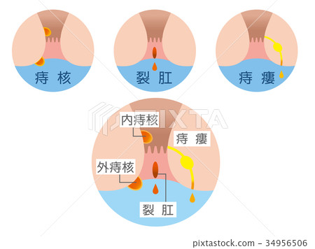 痔瘡症狀圖 34956506