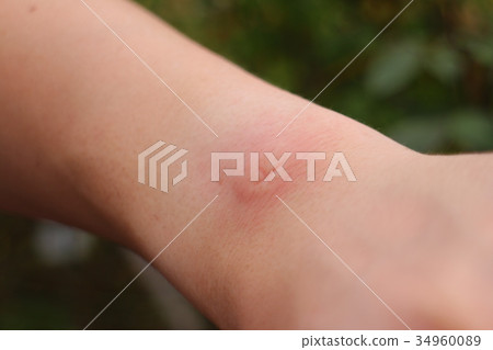 蚊子雄性的手臂 34960089